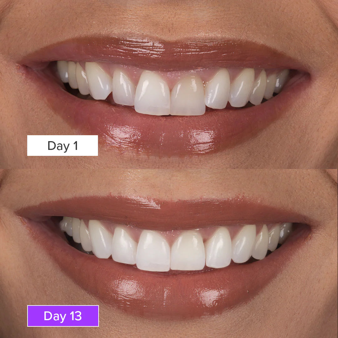 5D Teeth Whitening Strips Plus – Brightening Smile Care